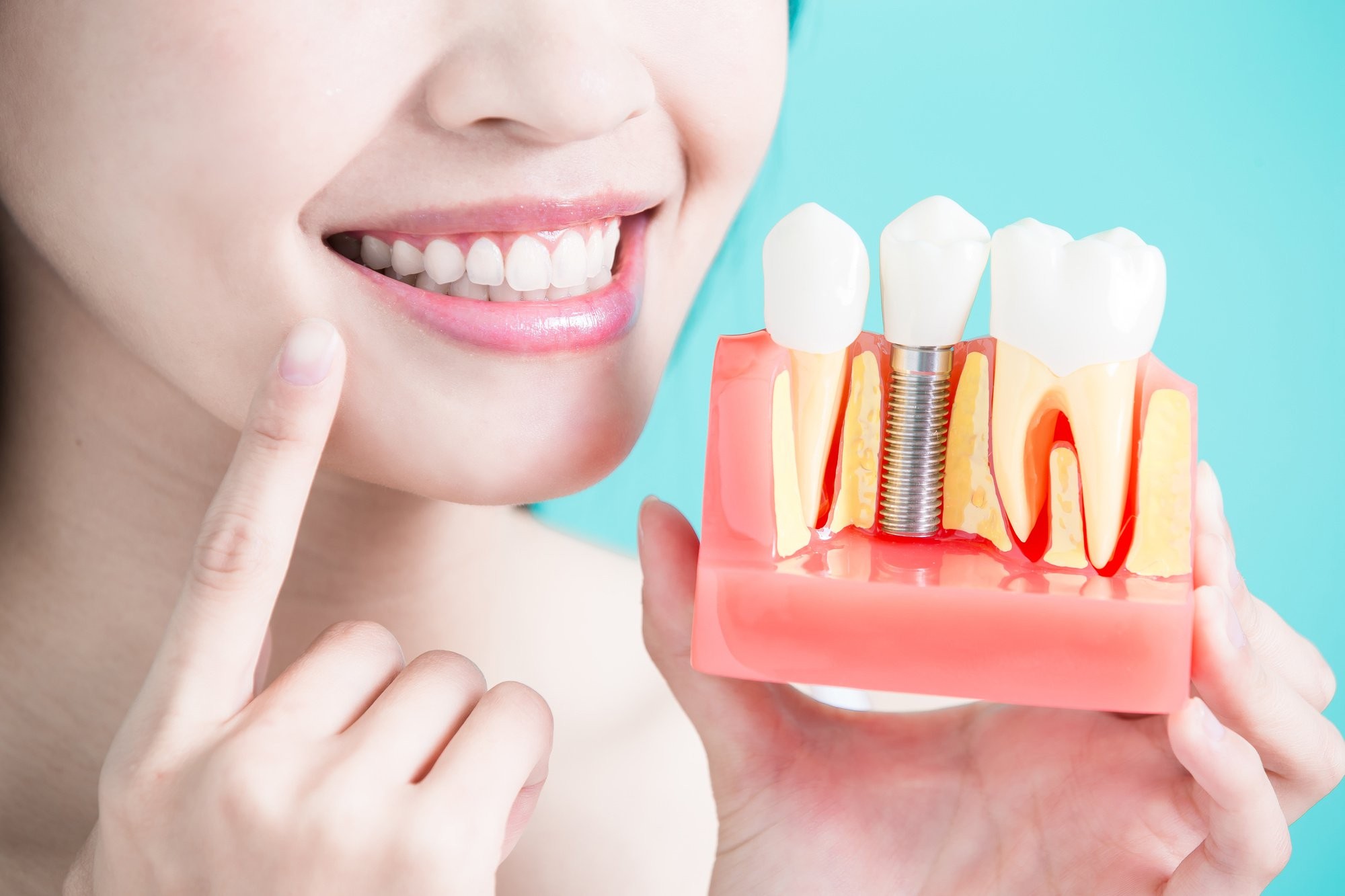 Dental implants image
